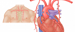 Аортокоронарное шунтирование (АКШ). О маммарно-коронарнарных шунтах
